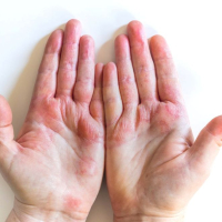 10 Things You Should Know About Eczema